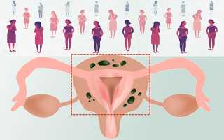Удаление матки при эндометриозе
