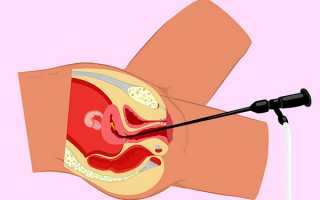 Важные нюансы проведения гистероскопии при эндометриозе