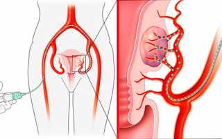Эмболизация маточных артерий как метод терапии миомы матки