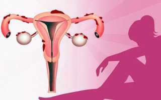 Типичные признаки эндометриоза у женщин