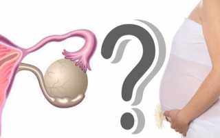 Беременность при фолликулярной кисте яичника