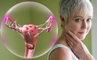 Эндометриоз у женщин после 40 лет и его лечение