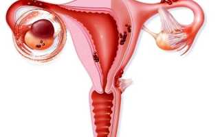 Эндометриоидная киста яичника и подходы к ее лечению