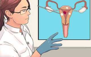 Радиоволновой миолиз как современный метод малоинвазивного лечения миомы матки