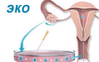 Нюансы проведения ЭКО при поликистозе яичников и единичной кисте