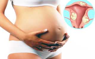 Возможна ли беременность при миоме матки?
