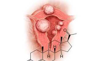 Роль прогестерона в развитии миомы матки