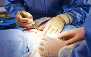 Полостная операция по удалению миомы матки