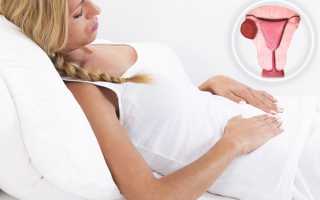Узловая форма аденомиоза матки и нюансы лечения этой патологии