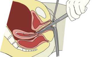 Процедура диагностического выскабливания полости матки при миоме
