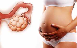 Наступление беременности на фоне поликистоза яичников