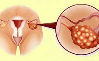 Причины поликистоза яичников и эффективные методы лечения