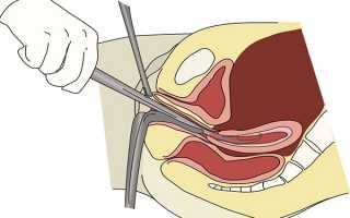 Процедура выскабливания матки при эндометриозе (так называемая «чистка матки»)