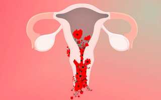 Что важно знать об аномальных маточных кровотечениях у женщин