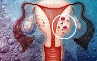 Специфика диффузной формы аденомиоза матки
