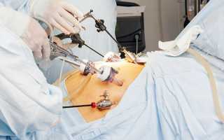 Лапароскопическая операция при эндометриозе