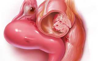 Эндометриоз кишечника и его лечение