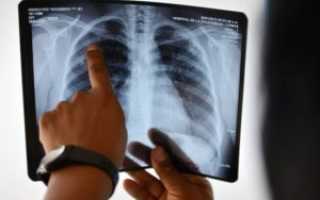 Диагностика туберкулеза: какие анализы рекомендовано сдавать