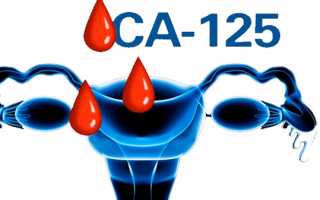 Анализ на онкомаркер СА-125 при кисте яичника