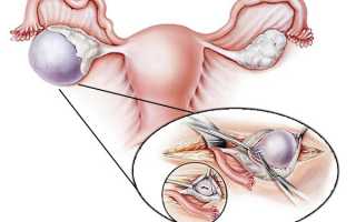 Процедура цистэктомии яичника